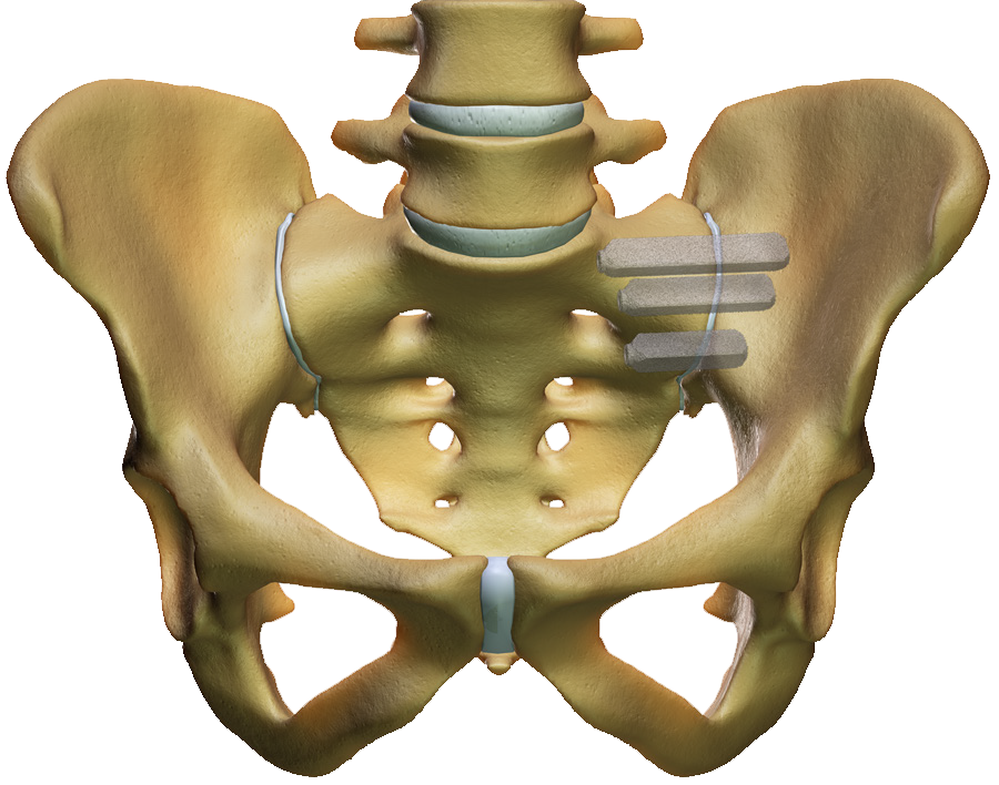 Nový produkt sakrální implantát iFuse na českém trhu